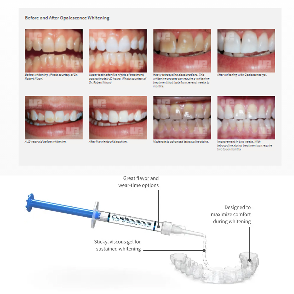 Opalescence Whitening 20% PF 2 - Teeth Whitening Kit At Home 评论和价格