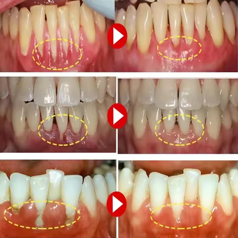 Teeth Whitening Gel Gum Repair - Teeth Whitening Gel 评论和价格