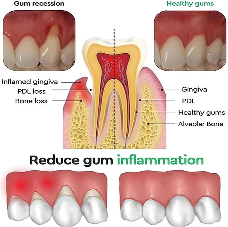 Teeth Whitening Gel Gum Repair - Teeth Whitening Gel 评论和价格