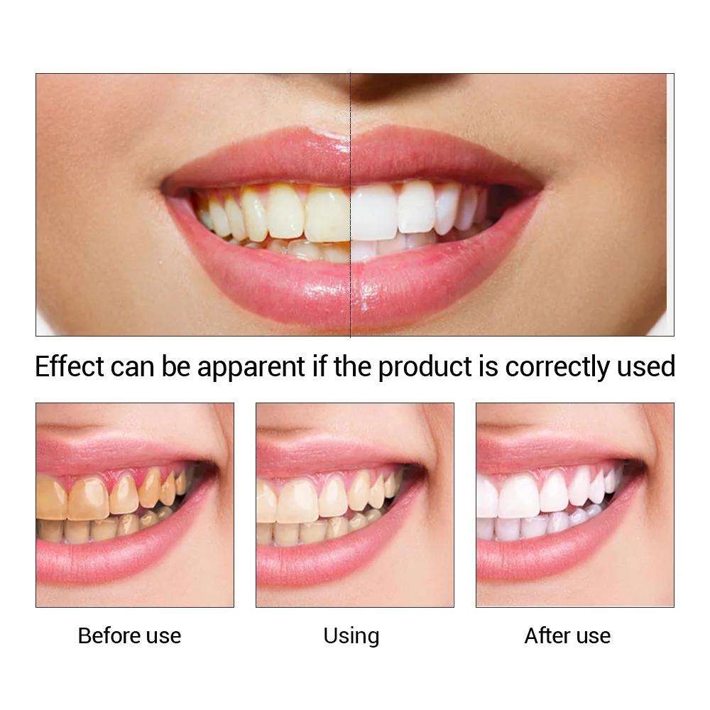 FTEENPLY Teeth Whitening Essen - Teeth Whitening App 评论和价格