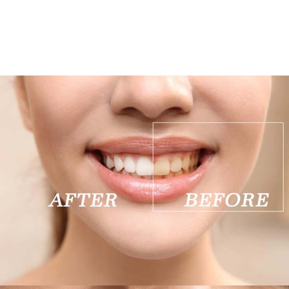 Top Quality Peroxide Teeth Whi - Teeth Whitening Gel 评论和价格
