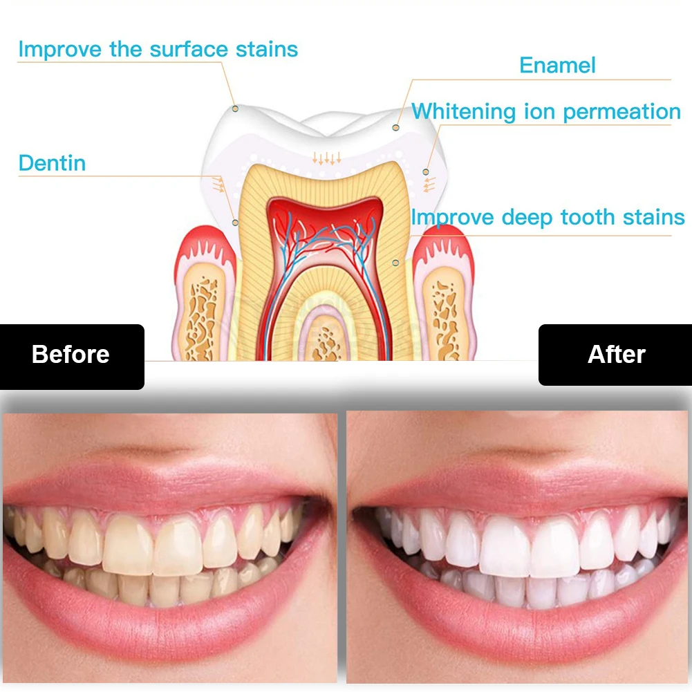 Dental Teeth Whitening Kit Min - Teeth Whitening Gel Peroxide 评论和价格